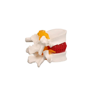 One Pathological Model of Spinal Vertebrae image 0