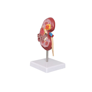 Pathological Kidney Model image 0