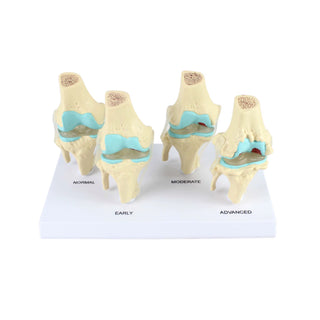 Stages of Knee OA