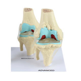 Stages of Knee OA