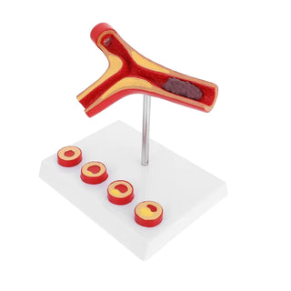 Human Arterial Thrombosis & Sclerosis Model