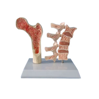 Osteoporosis Demonstration Model